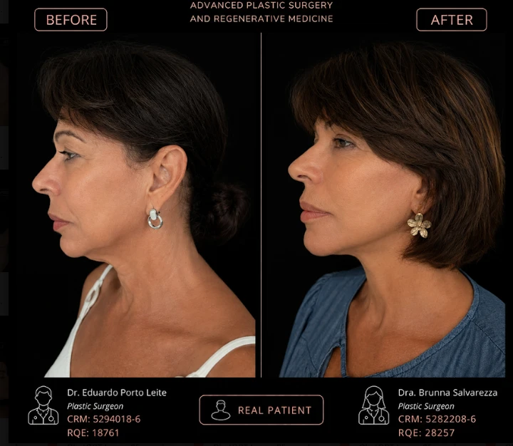 Caso 3 de lifting facial: antes e depois