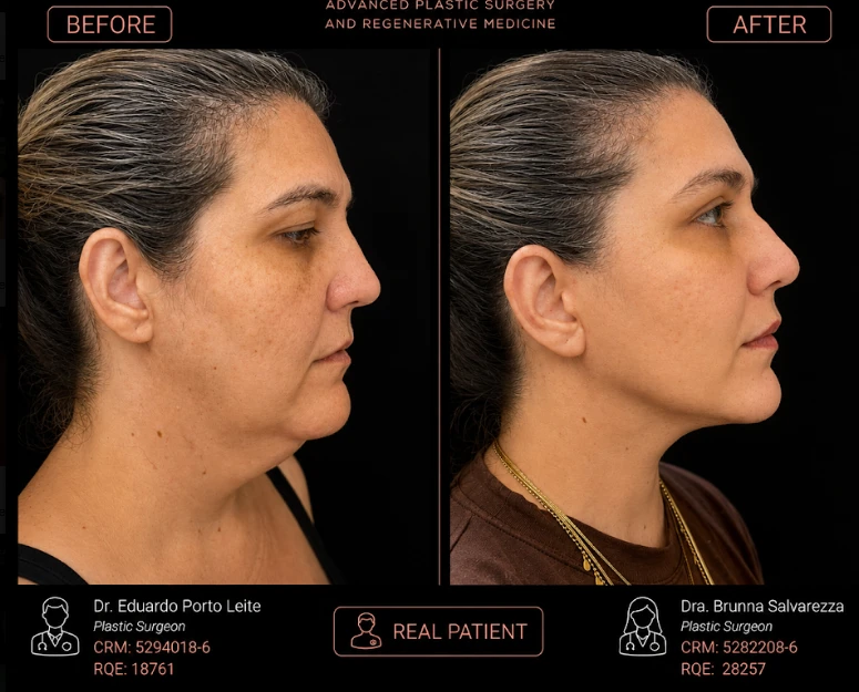 Caso 4 de lifting facial: antes e depois